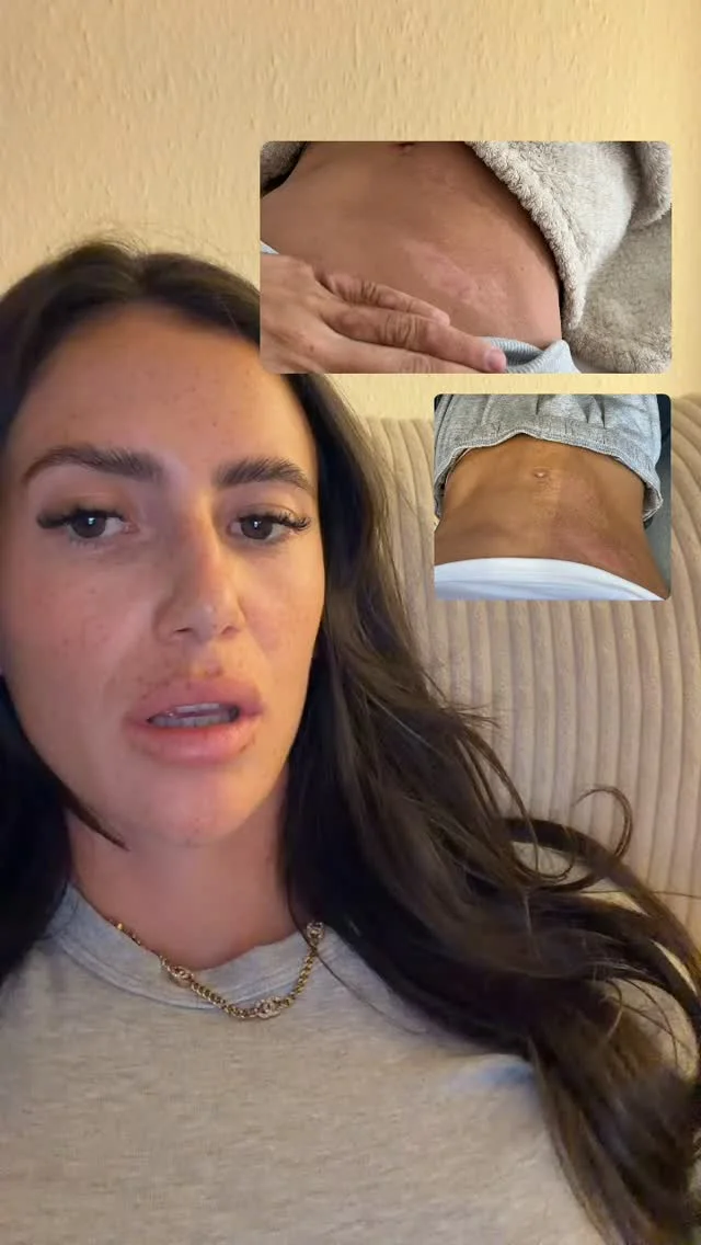 Anna Lisson bezweifelt Erklärung für rätselhafte Hautflecken bei "Are you the One"